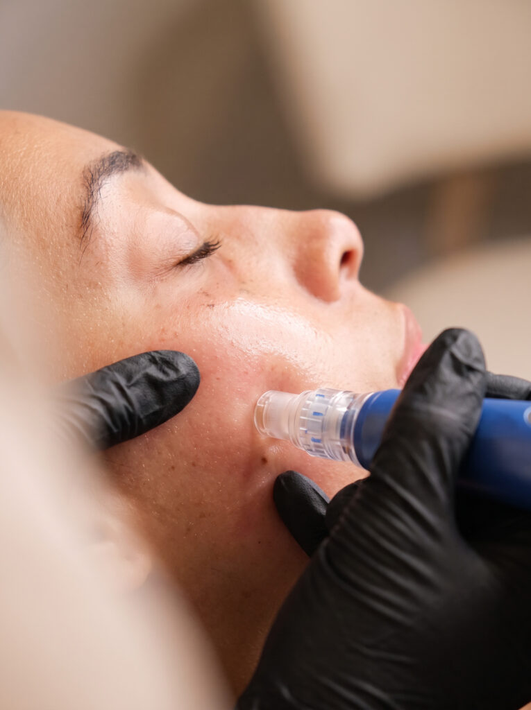 SkinPen Microneedling
